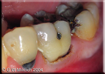 c6 tip gingivectomy 2 copy small.jpg